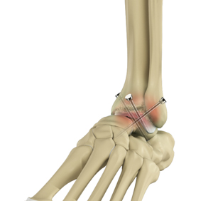 Ankle Fusion