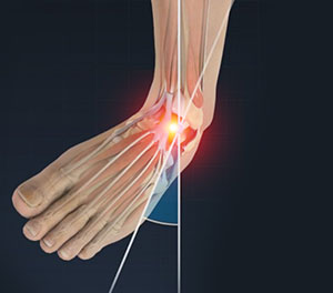 Ankle Sprain