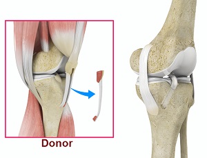 Bone-Patellar Tendon-Bone (BPTB) Allograft