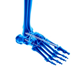 Charcot Foot Reconstruction