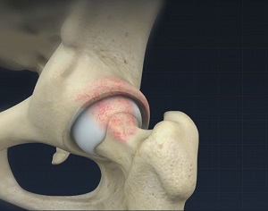 Femoroacetabular Osteoplasty