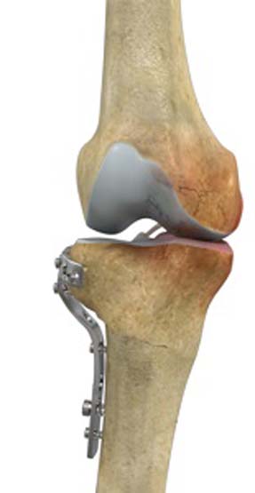 High Tibial Osteotomy