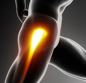 Open Gluteus Medius Repair