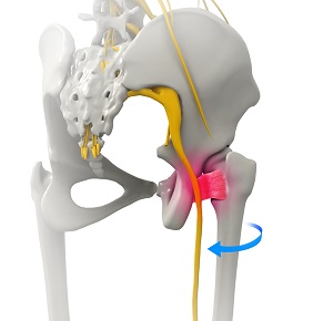 Ischiofemoral Impingement Decompression - Procedure