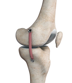 Multiligament Reconstruction of the Knee