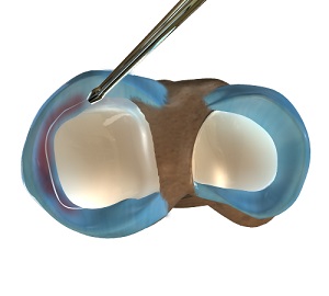 Partial Arthroscopic Meniscectomy