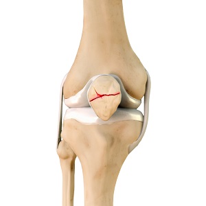 Fractures of the Patella