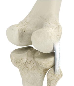 Posterolateral Corner (PLC) Reconstruction