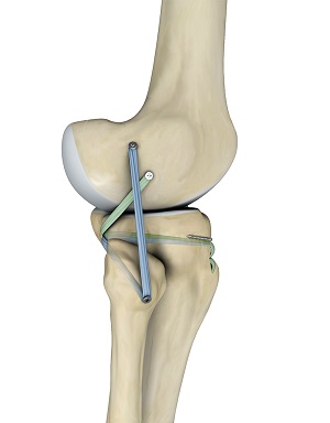 Posterolateral Corner Reconstruction