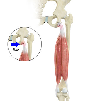 Proximal Hamstring Repair