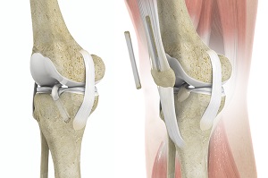 Quadriceps Tendon Autograft for Anterior Cruciate Ligament Reconstruction