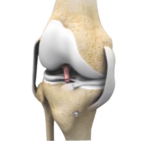 Revision Knee Ligament Reconstruction