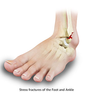 Stress Fractures of Foot and Ankle