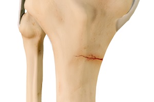 Stress Fracture of the Tibia