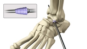 Subtalar Arthrodesis