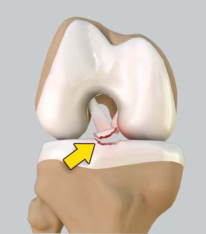 Tibial Eminence Fractures