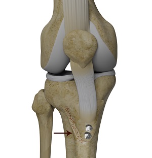 Tibial Tubercle Transfer