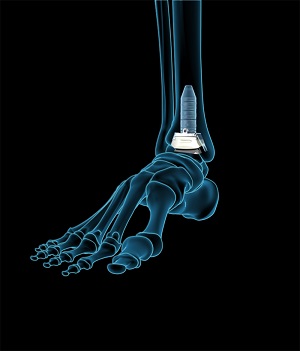 What is a Foot & Ankle Orthopaedic Surgeon?